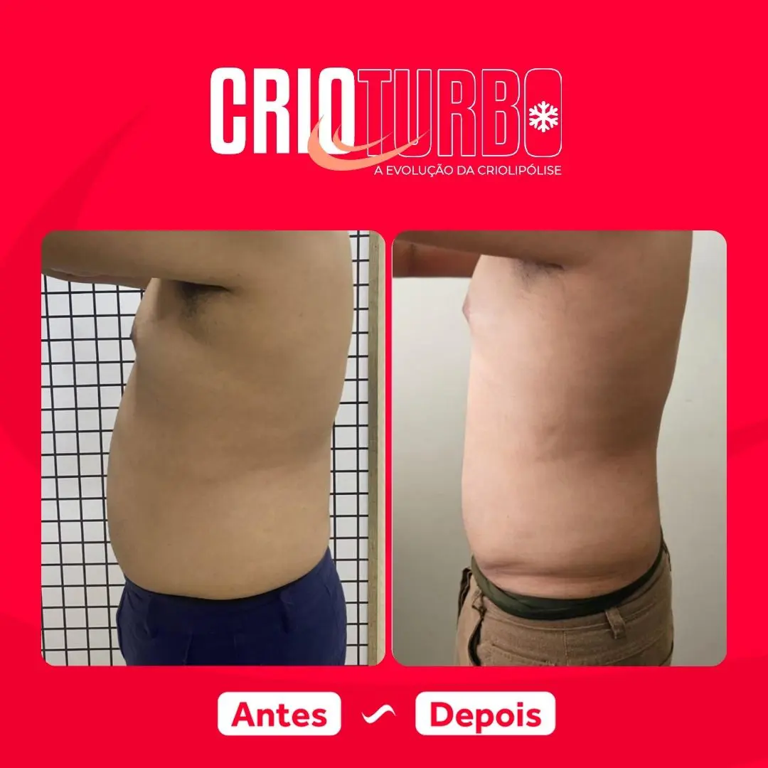 Antes e depois de Crioturbo no abdômen