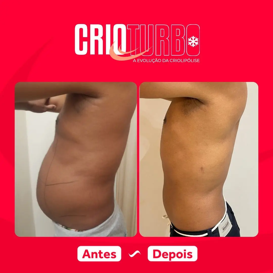 Antes e depois de Crioturbo na cintura