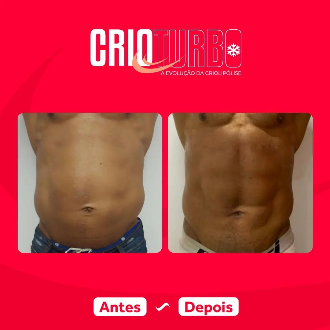 Antes e depois de Crioturbo em abdômen masculino